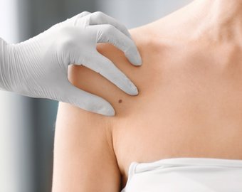 Бесплатная акция, приуроченная ко Всемирному дню борьбы с меланомой