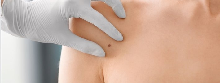 Бесплатная акция, приуроченная ко Всемирному дню борьбы с меланомой