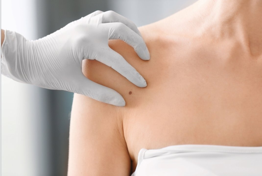 Melanoma day